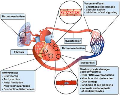 viral myocarditis bradycardia